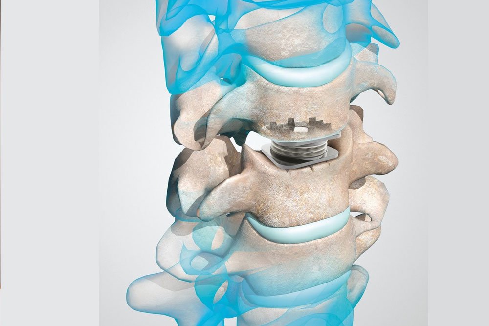 Cervical Disc Replacement in 