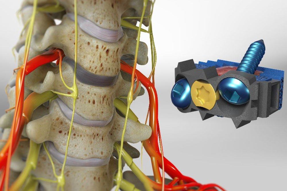 Cervical Discectomy Surgery in 