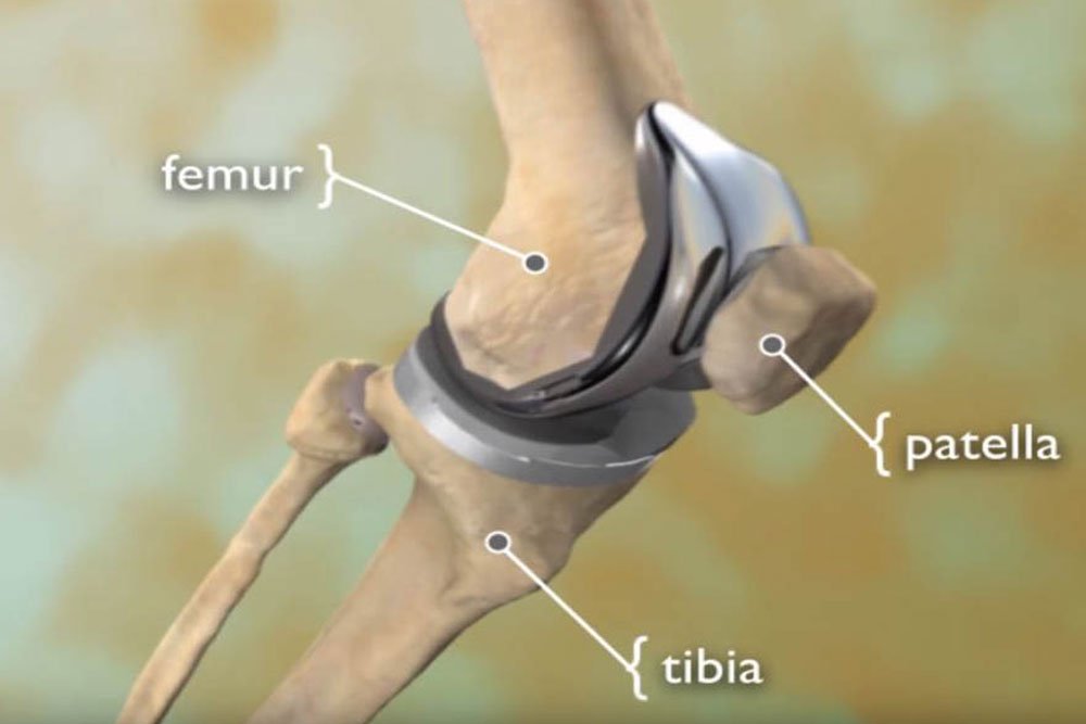 Joint Replacement in 