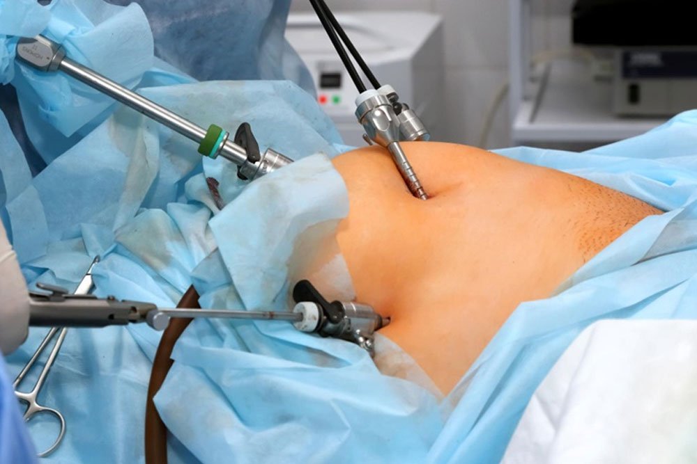 Laparoscopic Surgery in 