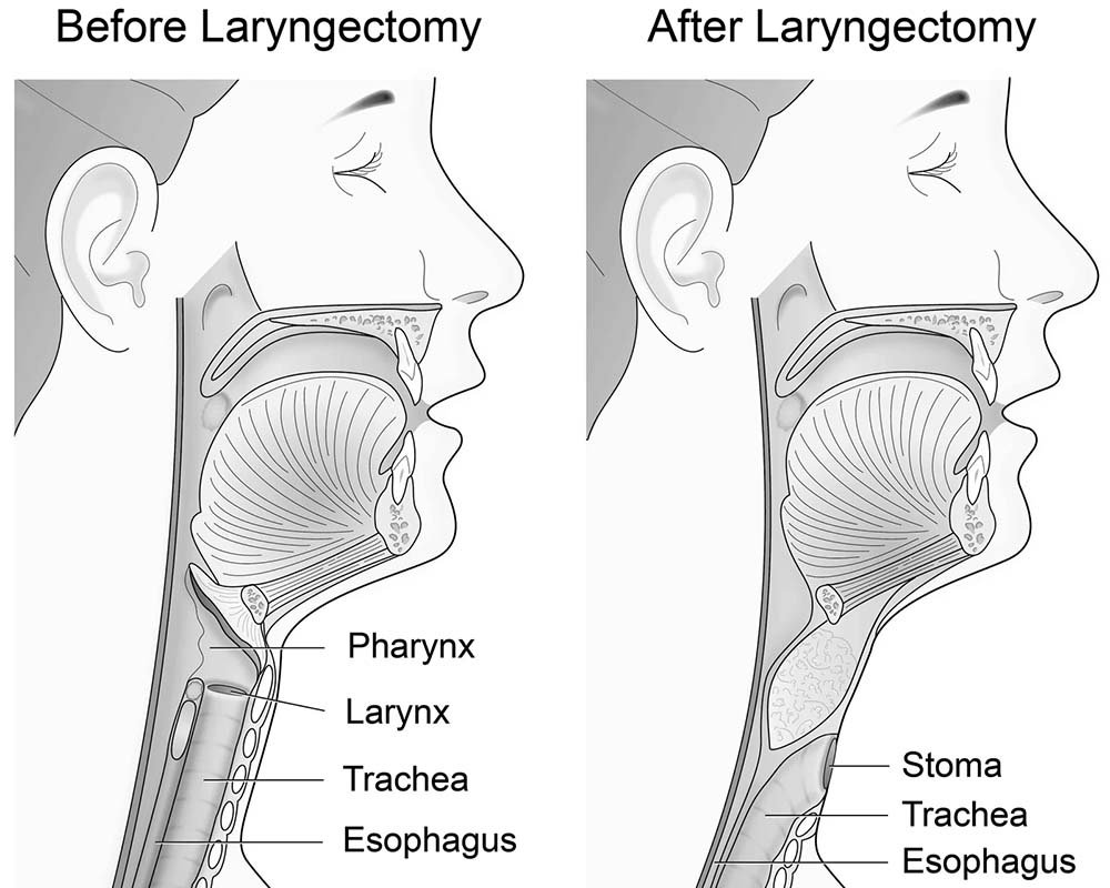 Laryngectomy Surgery in 