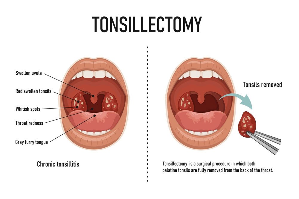 Tonsillectomy Surgery in 
